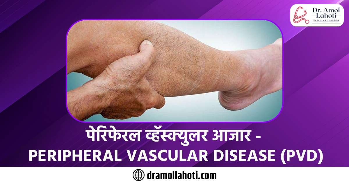 <strong>पेरिफेरलव्हॅस्क्युलरआजार – Peripheral Vascular Disease (PVD) in Marathi</strong>