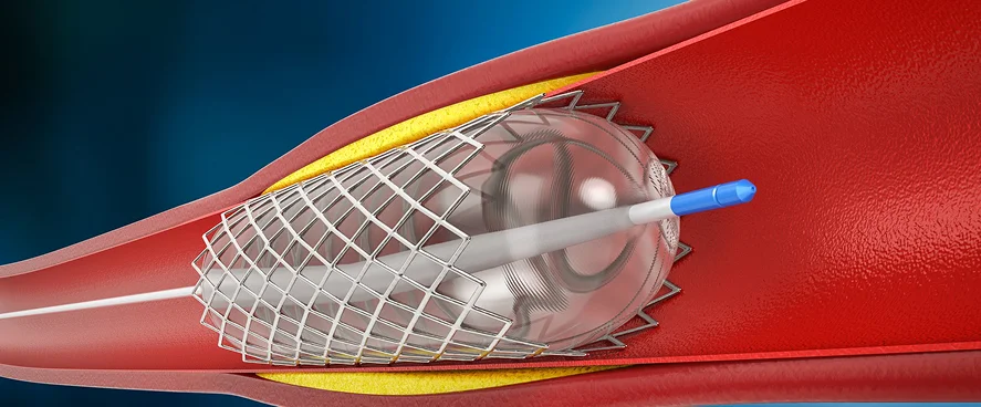 Vascular Surgery in Aurangabad by Dr Amol Lahoti